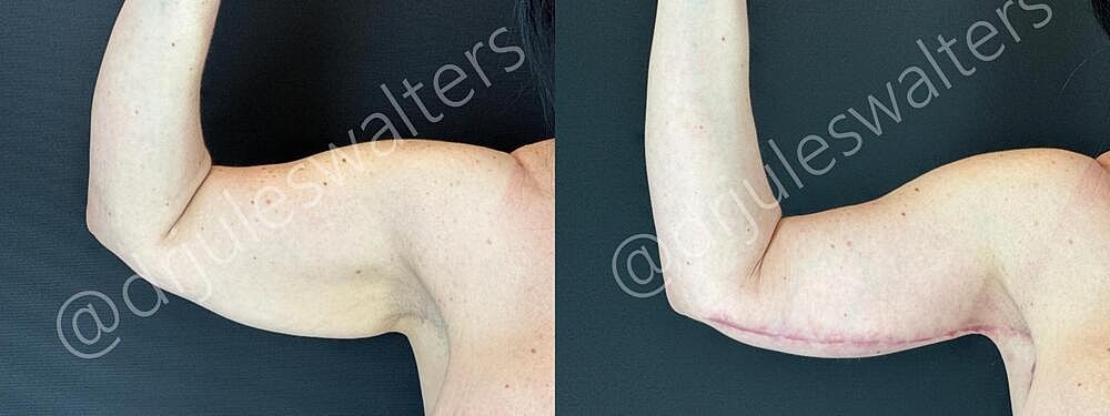 Arm Lift Brachioplasty Before & After