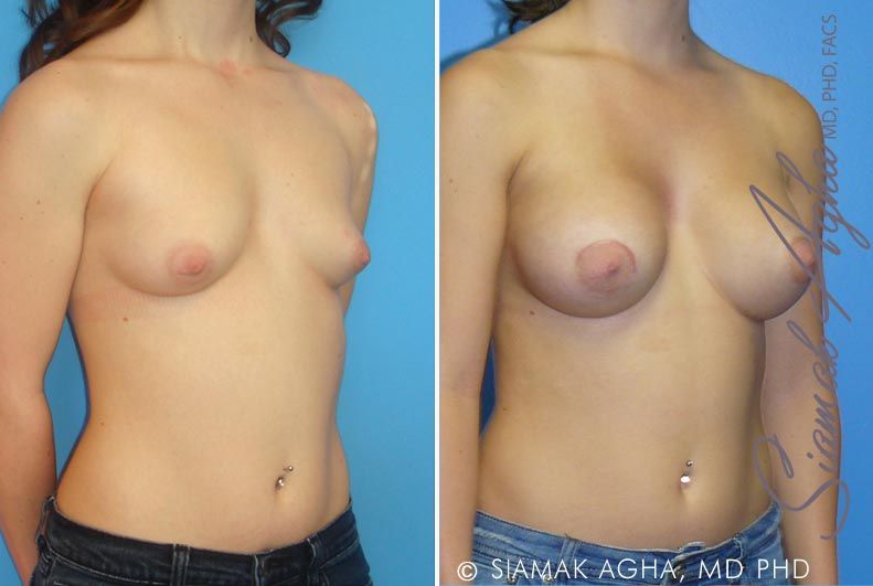 Tubular Breast Correction Before & After