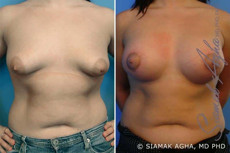 Tubular Breast Correction Before & After