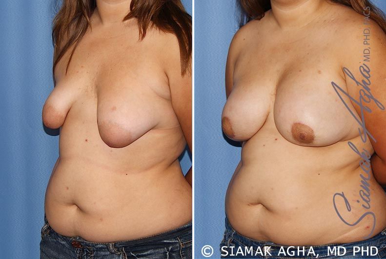 Tubular Breast Correction Before & After