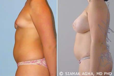 Tubular Breast Correction Before & After