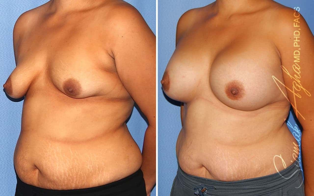 Tubular Breast Correction Before & After