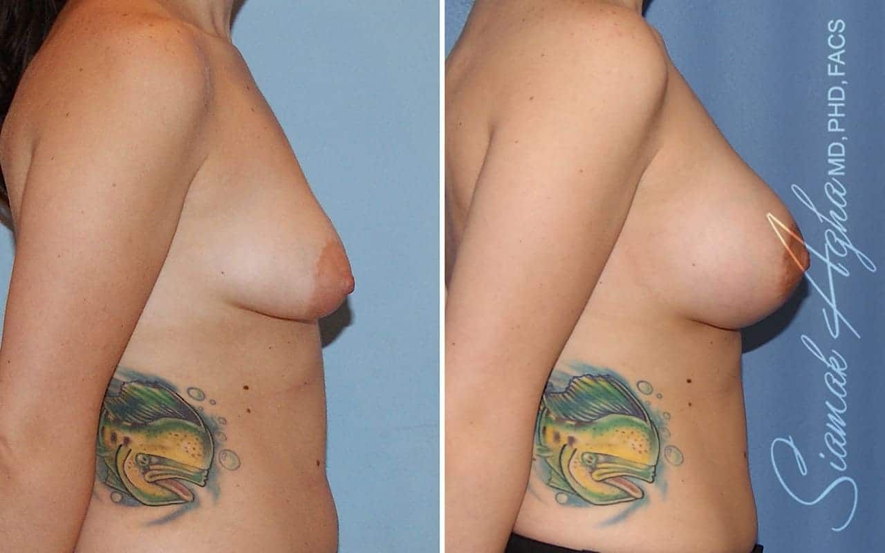 Tubular Breast Correction Before & After
