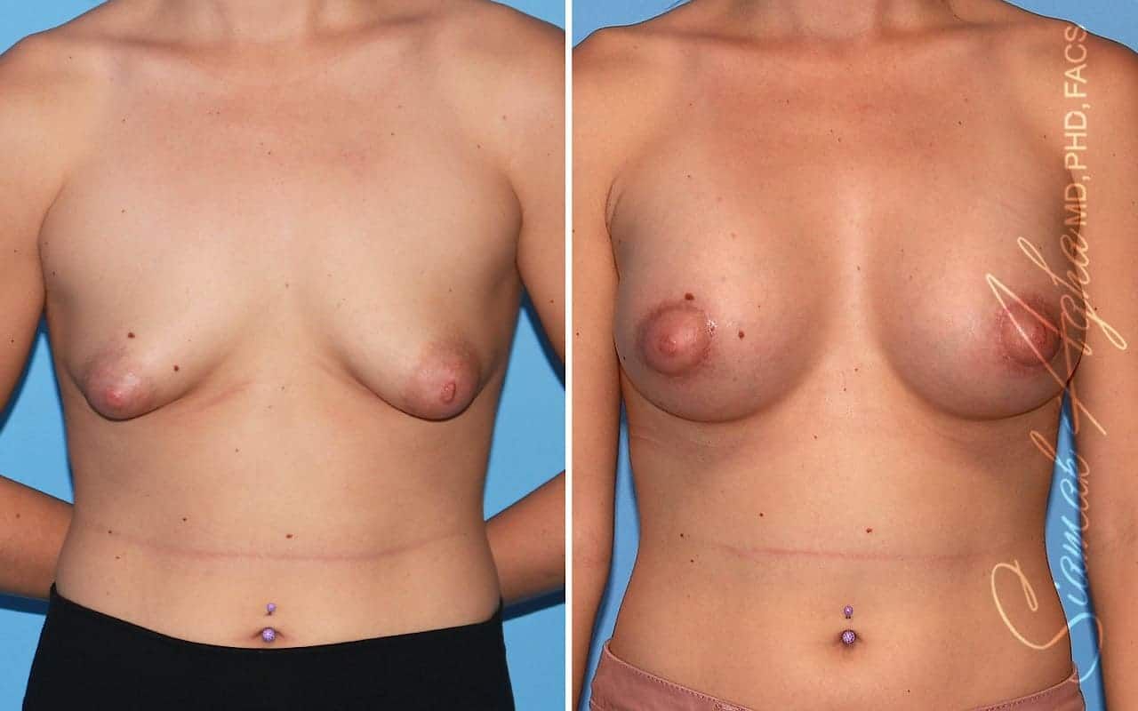 Tubular Breast Correction Before & After