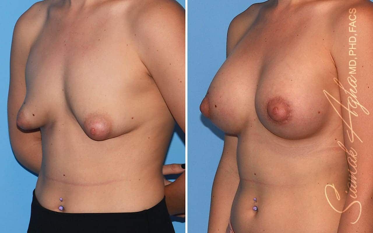 Tubular Breast Correction Before & After