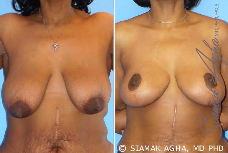 Breast Lift Before & After