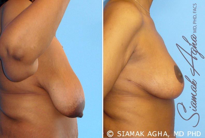 Breast Lift Before & After