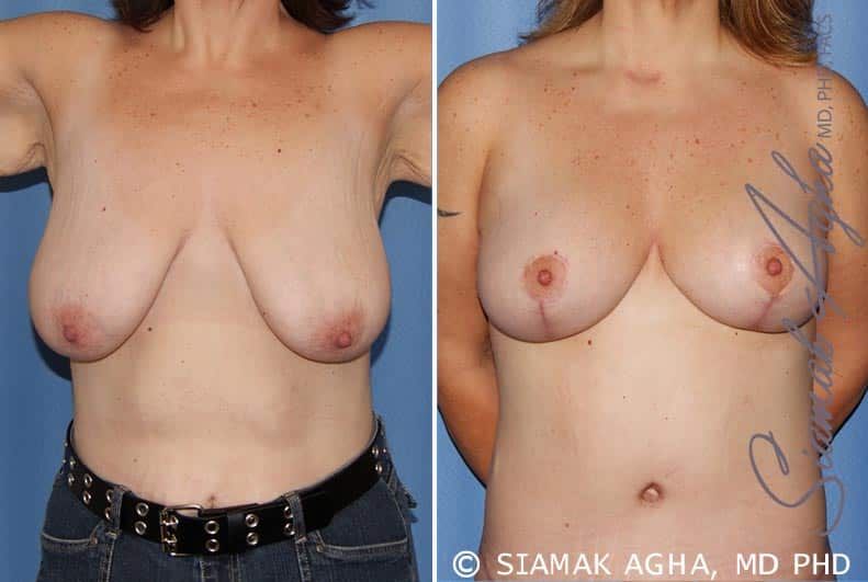 Breast Lift Before & After