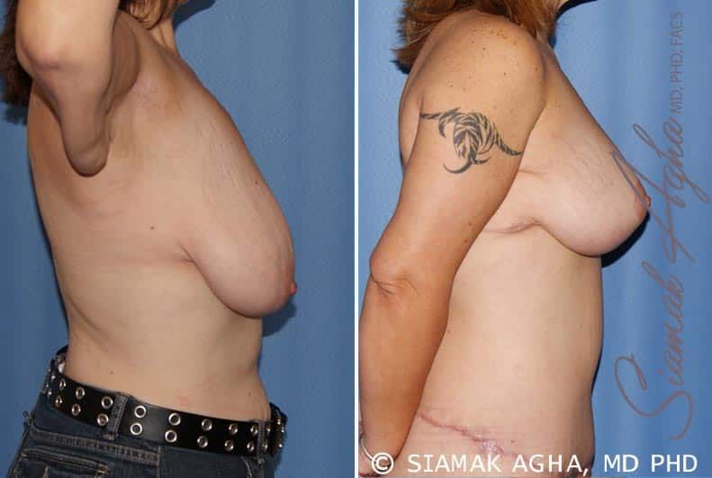 Breast Lift Before & After