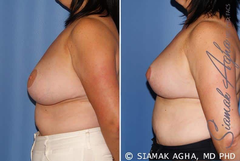 Breast Lift Before & After
