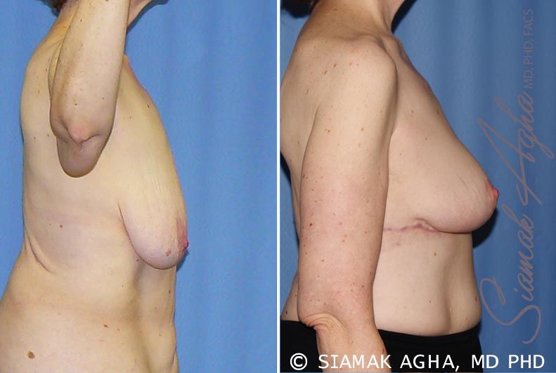 Breast Lift Before & After