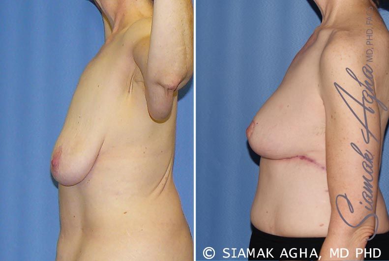 Breast Lift Before & After