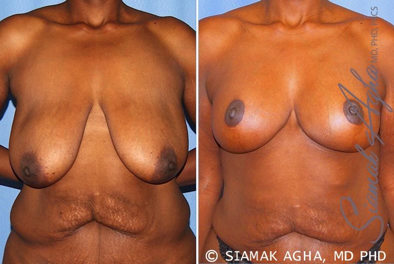 Breast Lift Before & After