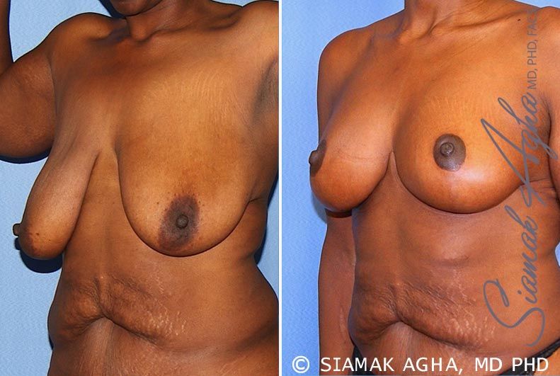 Breast Lift Before & After