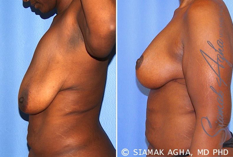 Breast Lift Before & After