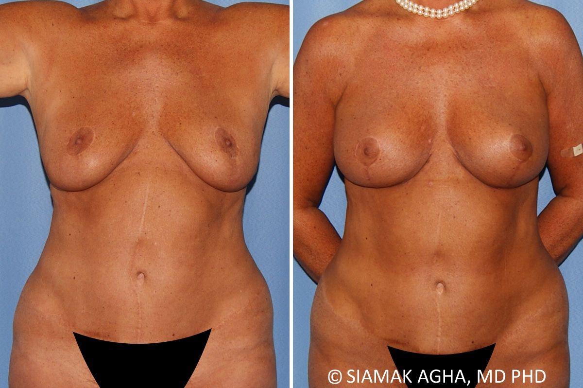 Breast Lift Before & After