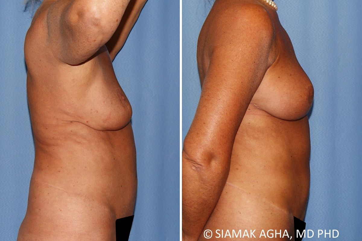 Breast Lift Before & After