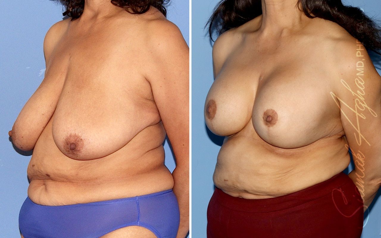 Breast Lift Before & After