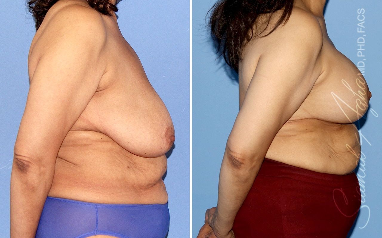 Breast Lift Before & After