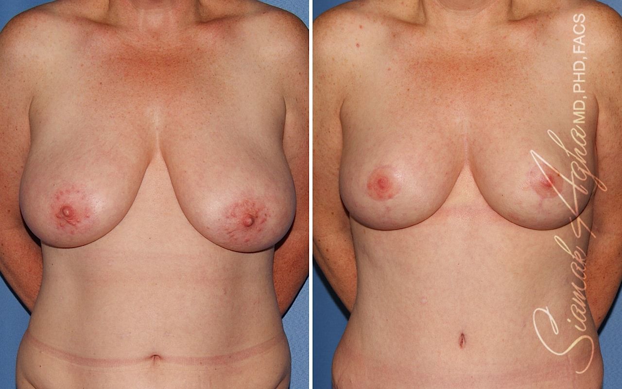 Breast Lift Before & After