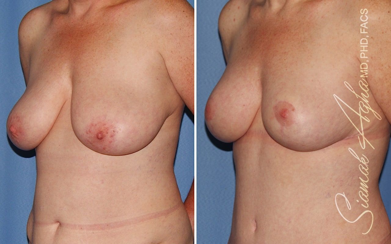 Breast Lift Before & After