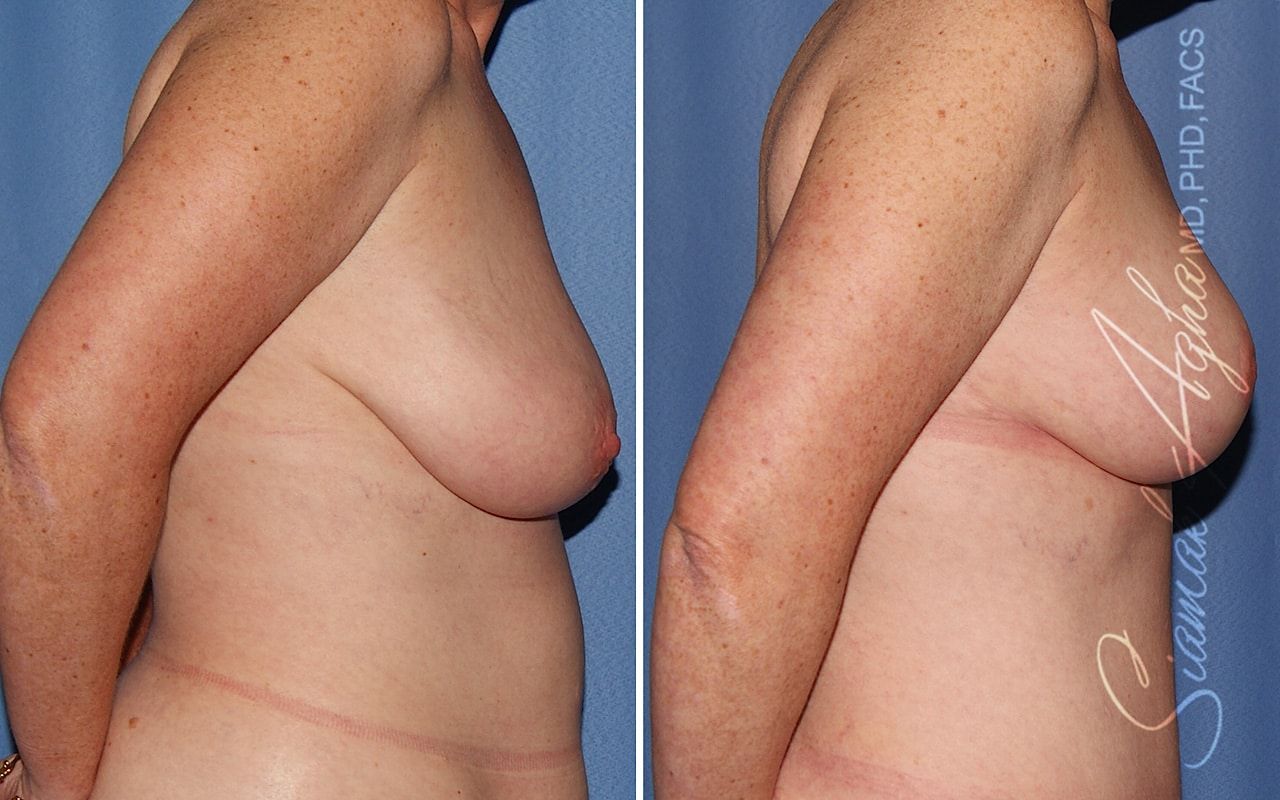 Breast Lift Before & After