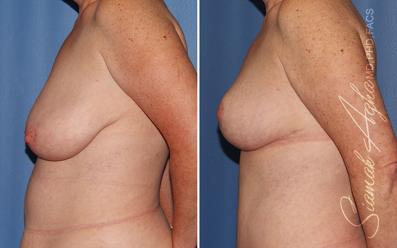 Breast Lift Before & After