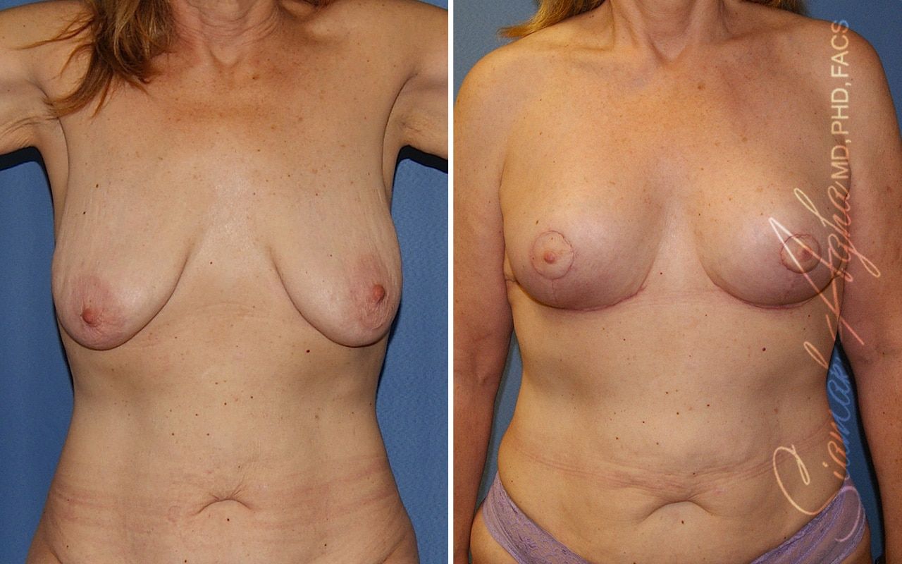 Breast Lift Before & After