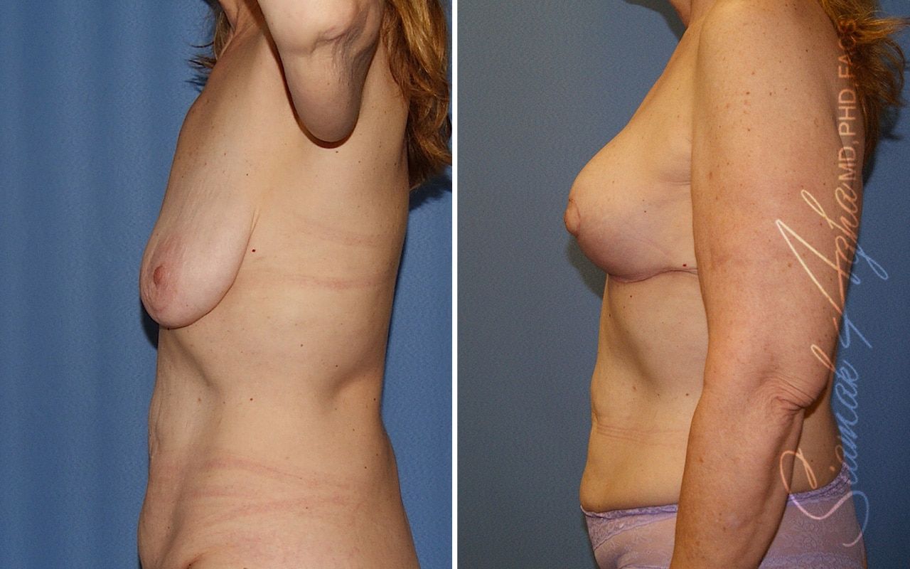 Breast Lift Before & After