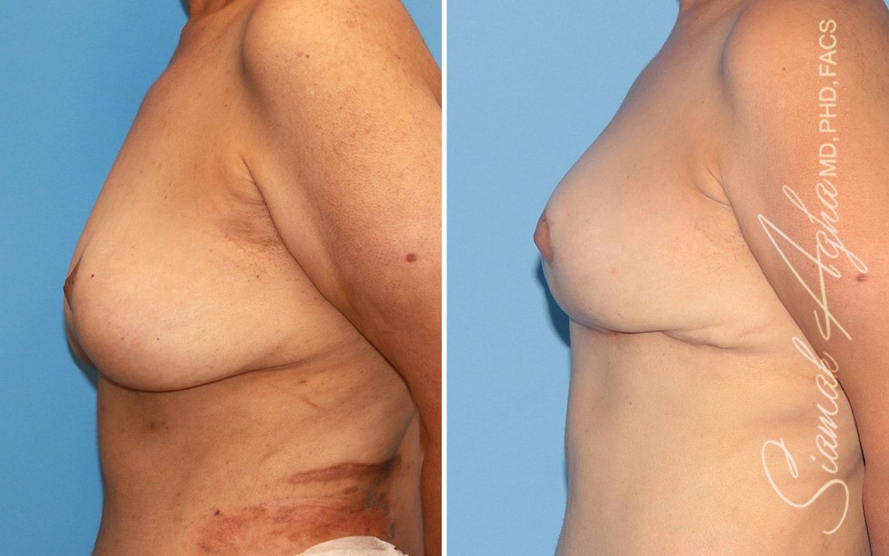 Breast Lift Before & After