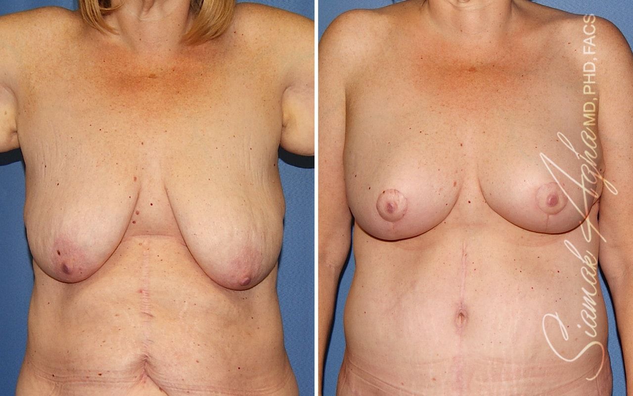 Breast Lift Before & After