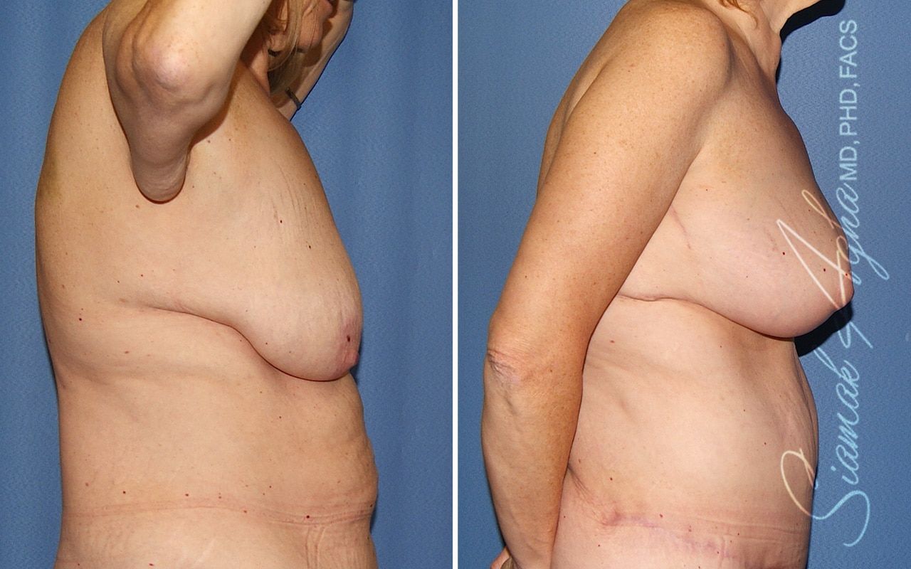 Breast Lift Before & After