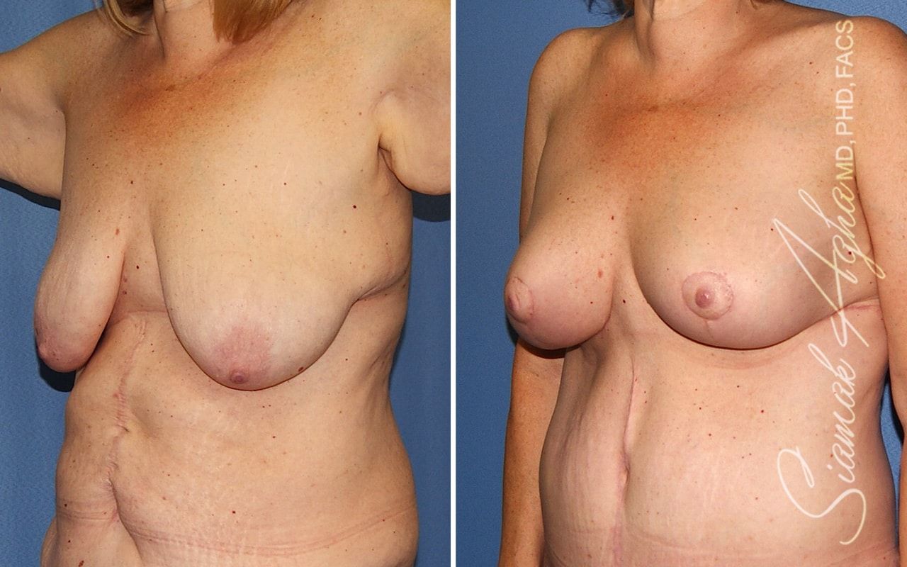 Breast Lift Before & After