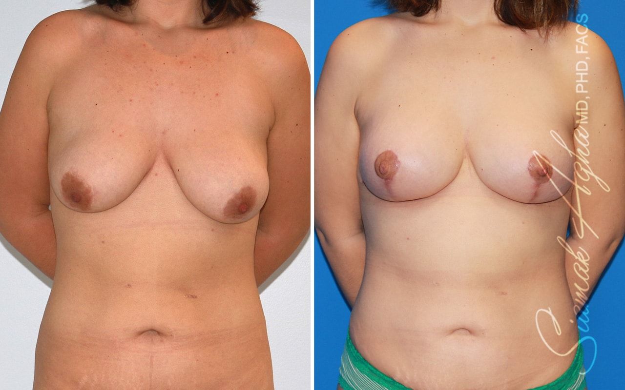 Breast Lift Before & After