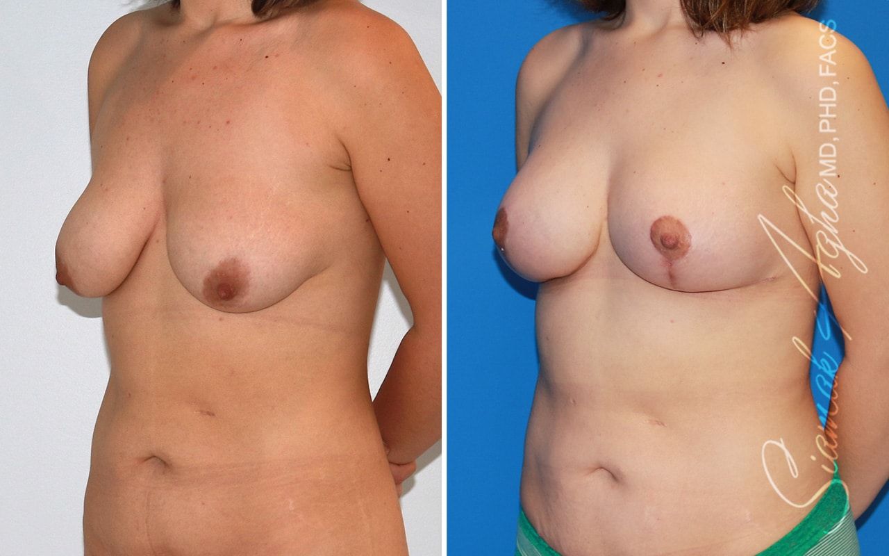 Breast Lift Before & After