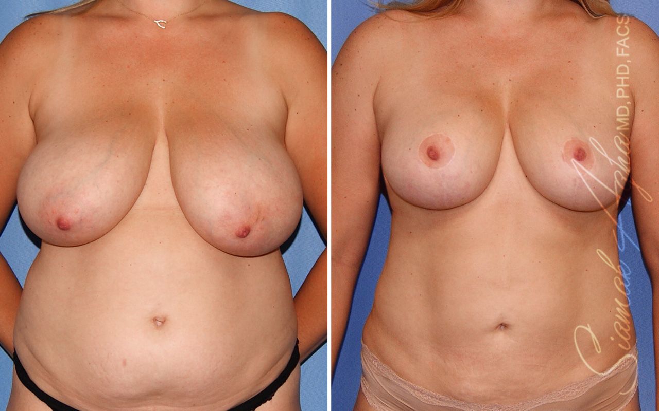Breast Lift Before & After