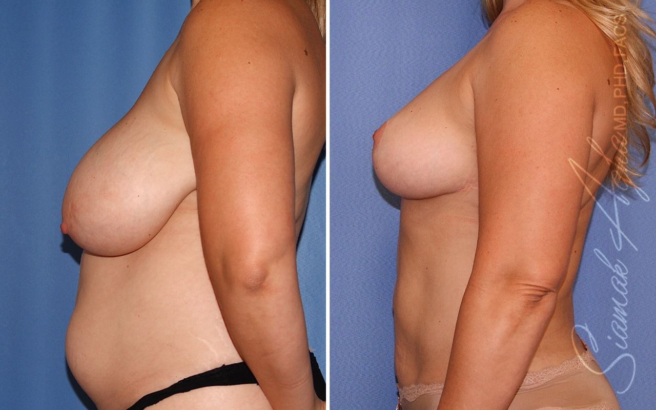 Breast Lift Before & After