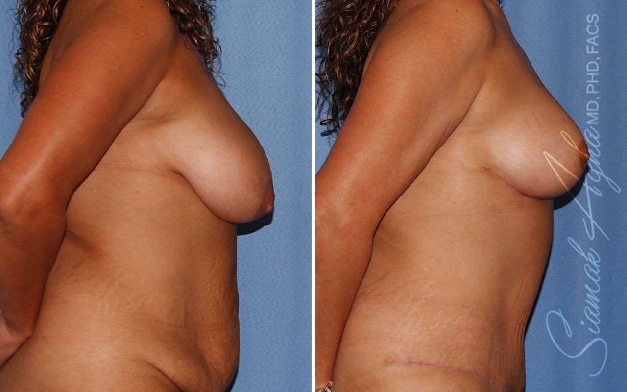 Breast Lift Before & After