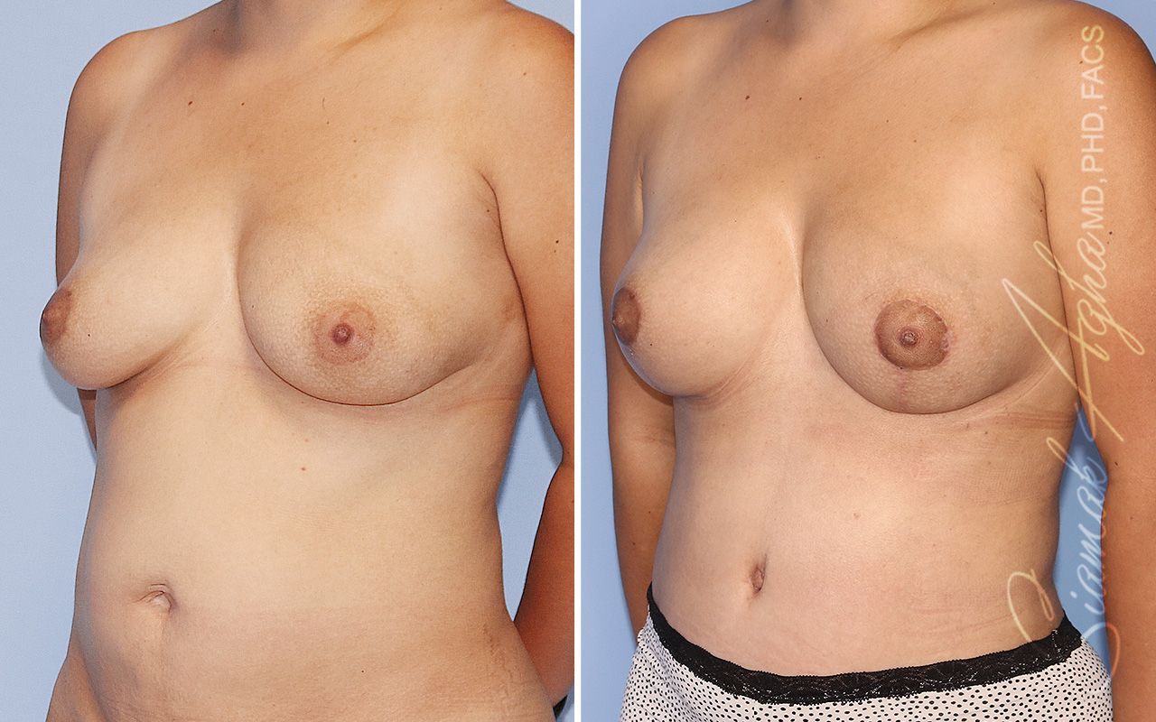 Breast Lift Before & After