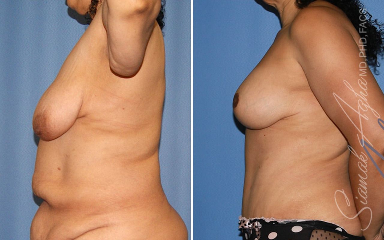 Breast Lift Before & After