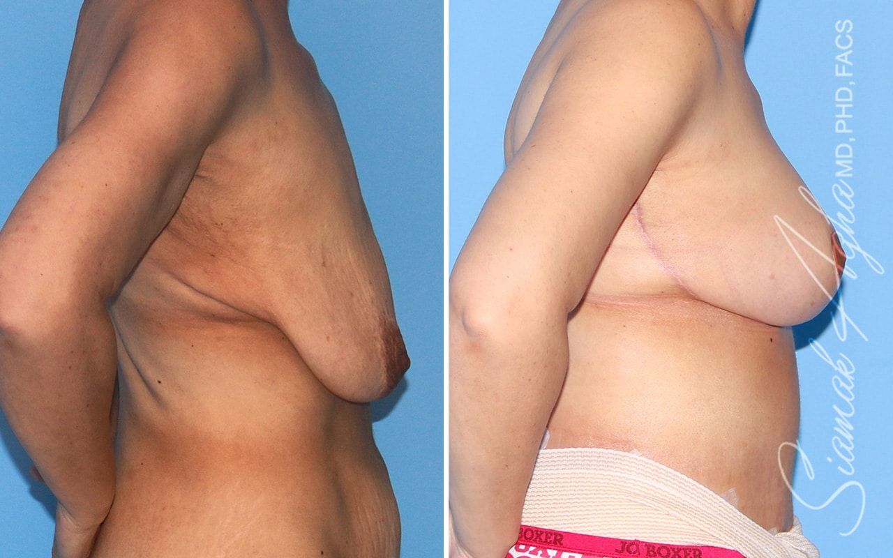 Breast Lift Before & After