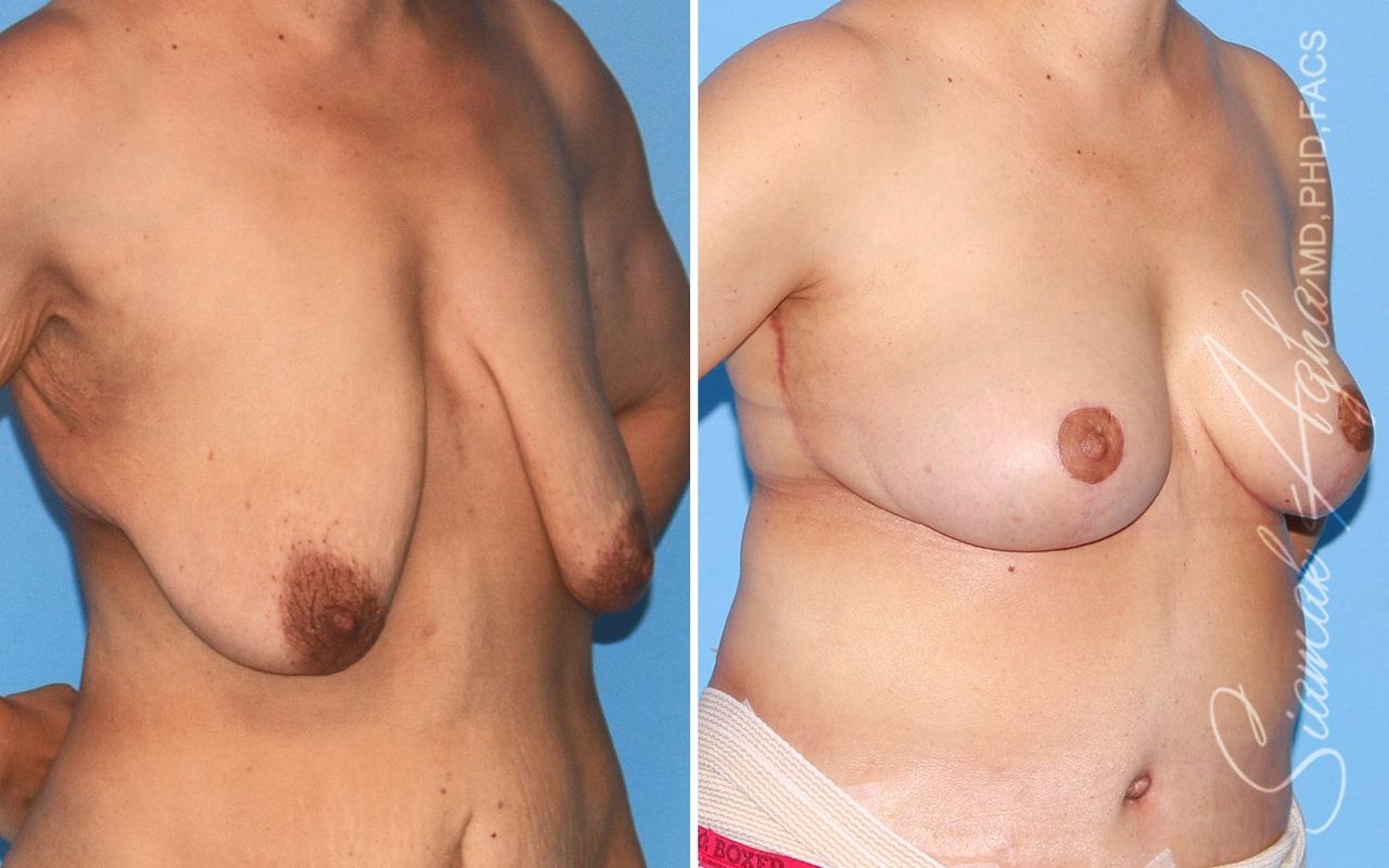Breast Lift Before & After