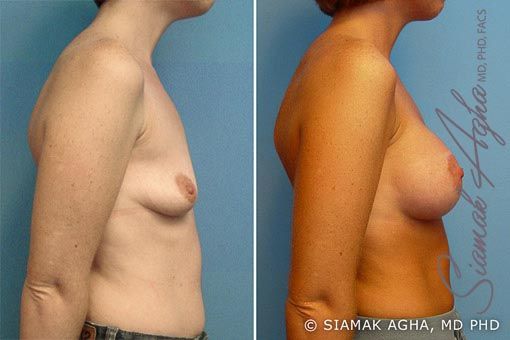 Breast Lift With Augmentation Before & After