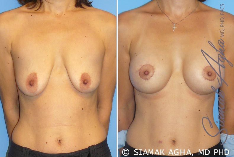 Breast Lift With Augmentation Before & After
