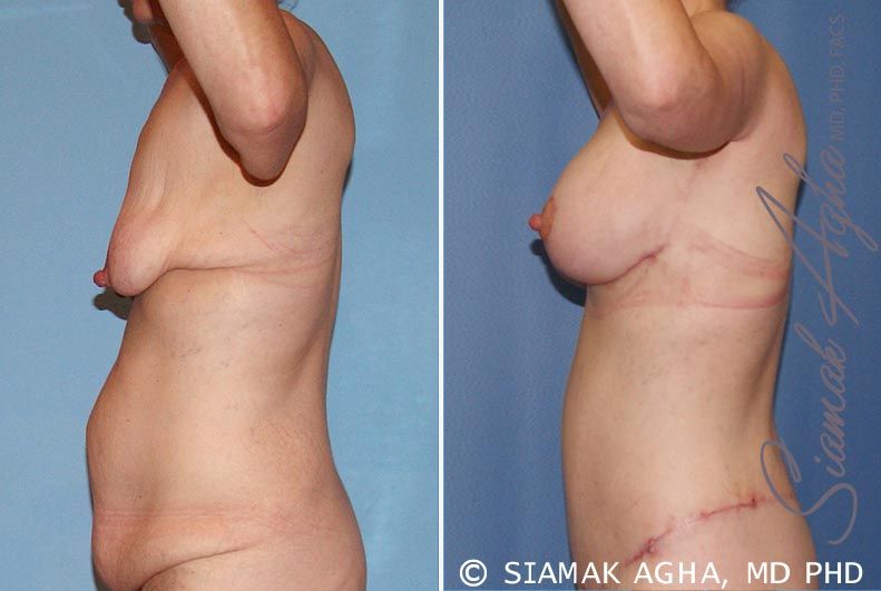 Breast Lift With Augmentation Before & After