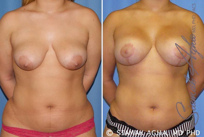 Breast Lift With Augmentation Before & After