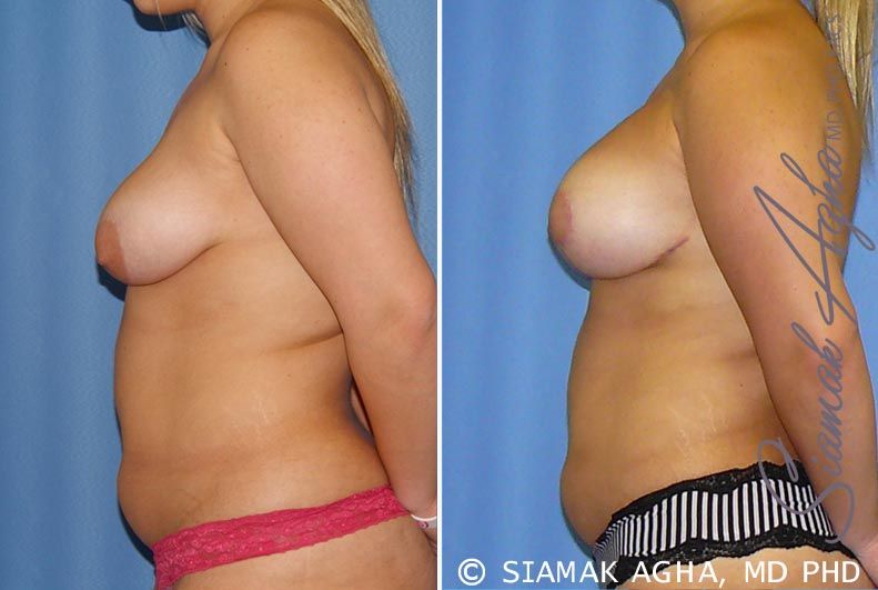 Breast Lift With Augmentation Before & After