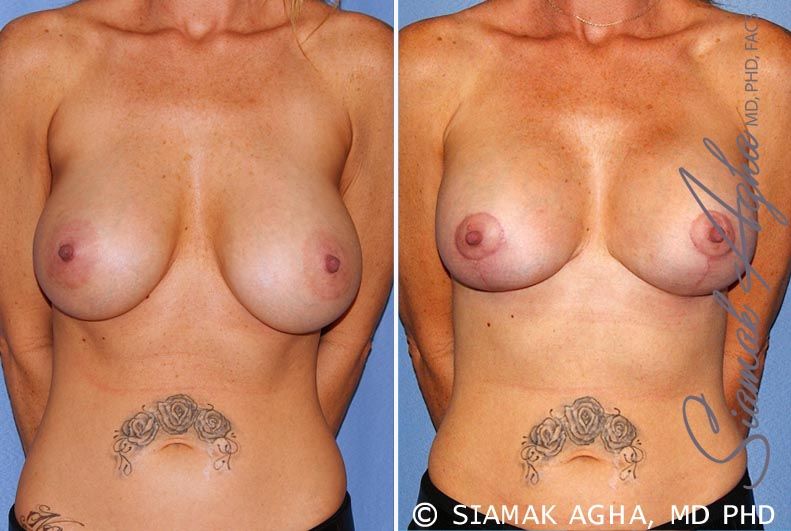 Breast Lift With Augmentation Before & After