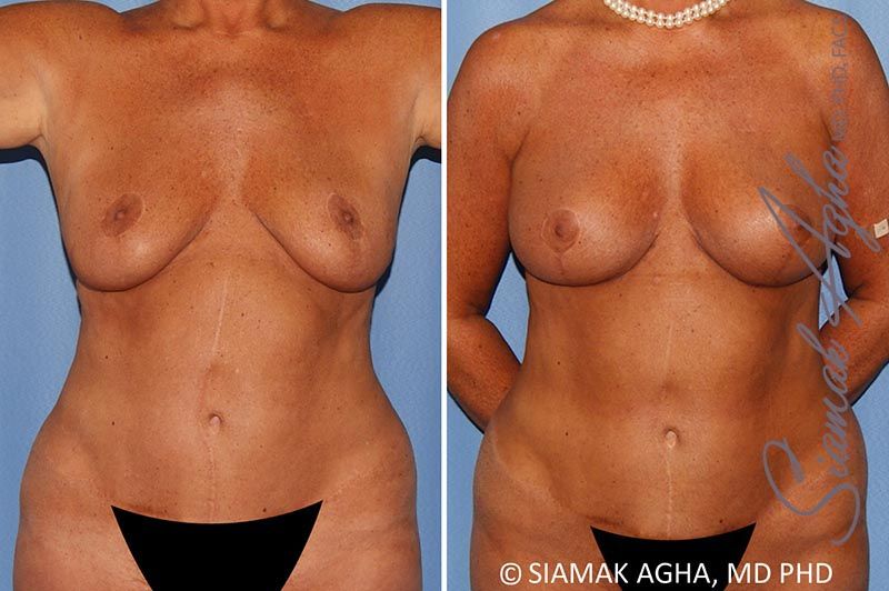 Breast Lift With Augmentation Before & After