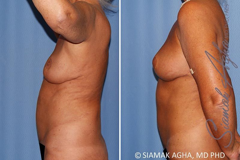 Breast Lift With Augmentation Before & After